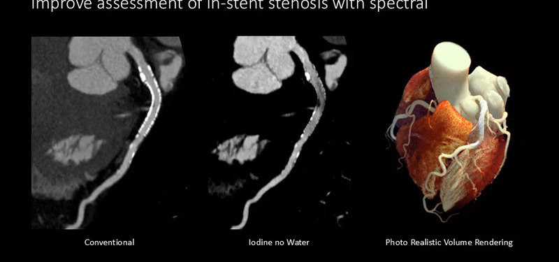 Система компьютерной томографии Philips Spectral CT 7500